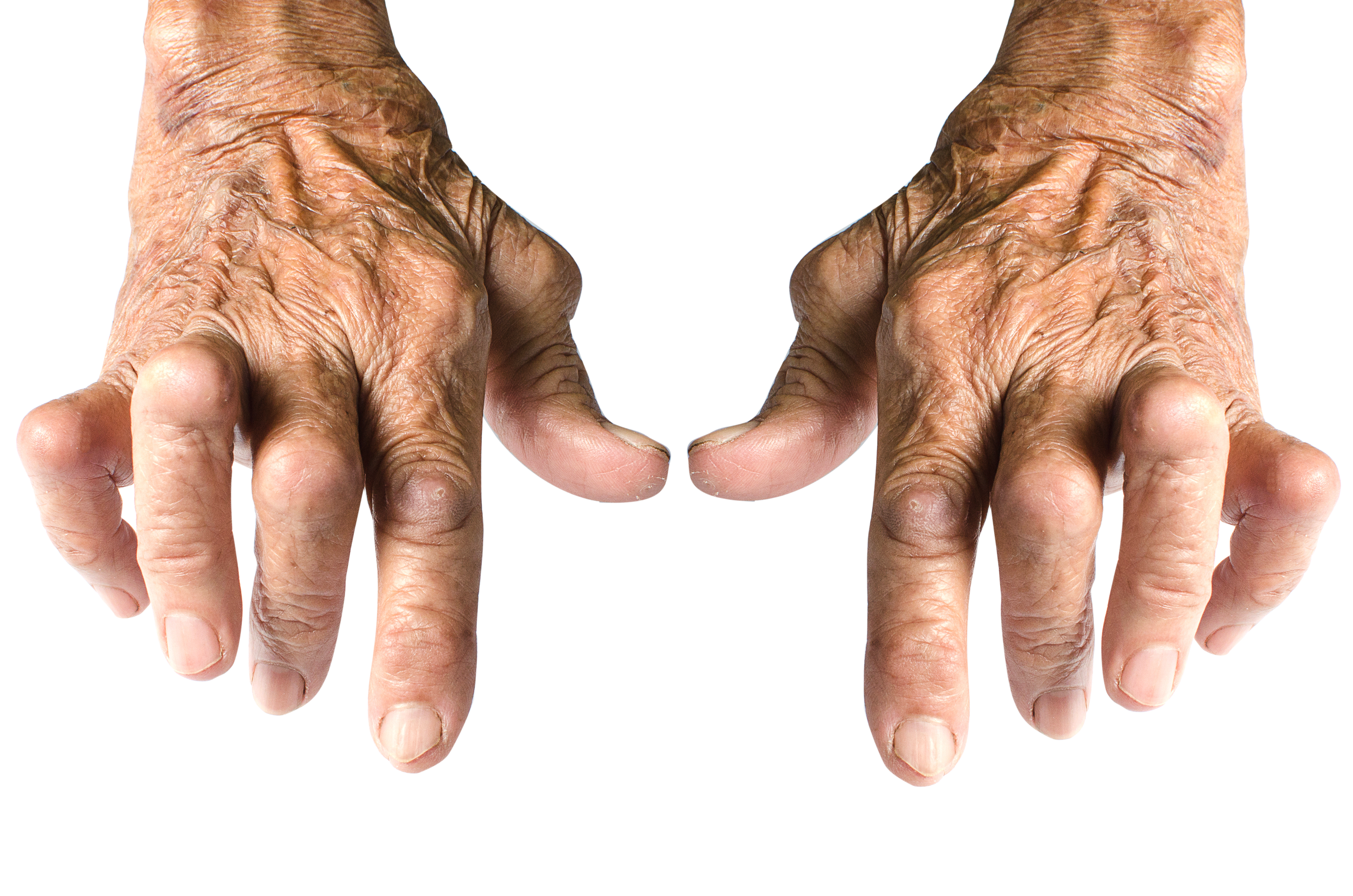 Ревматоидный артрит суставов кистей. Ревматоидный артири т. Ревматоидный артрит кистей рук. Серонегативный ревматоидный полиартрит.